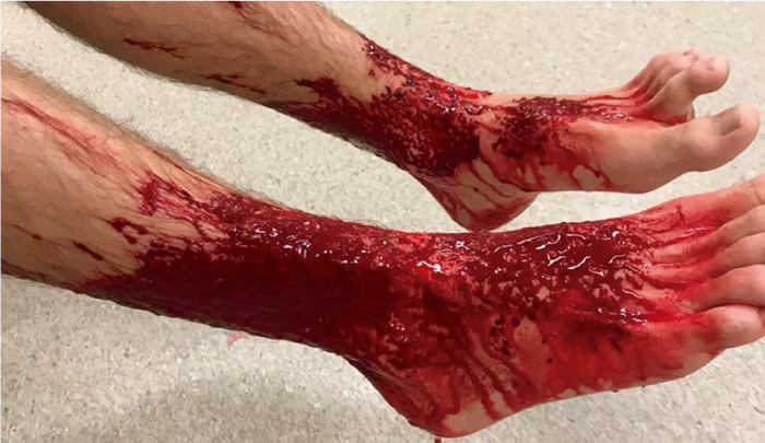 Desconocidas criaturas marinas se "comen" la pierna de joven en playa de Australia   