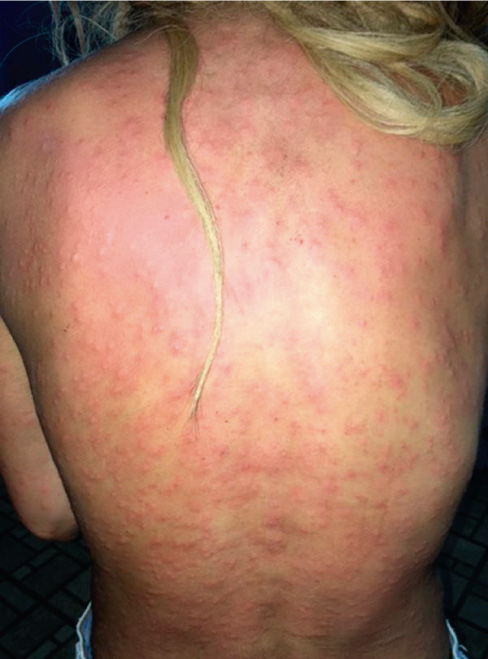 As&iacute; qued&oacute; la espalda de Anastasia Ashley tras ser picada por ciento de mosquitos 
