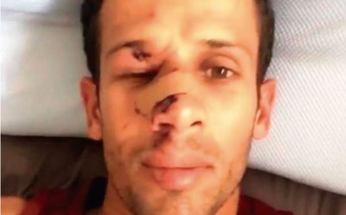As&iacute; qued&oacute; el rostro de Bino Lopez tras su encuentro con los pilotes del muelle en Huntington Beach 
