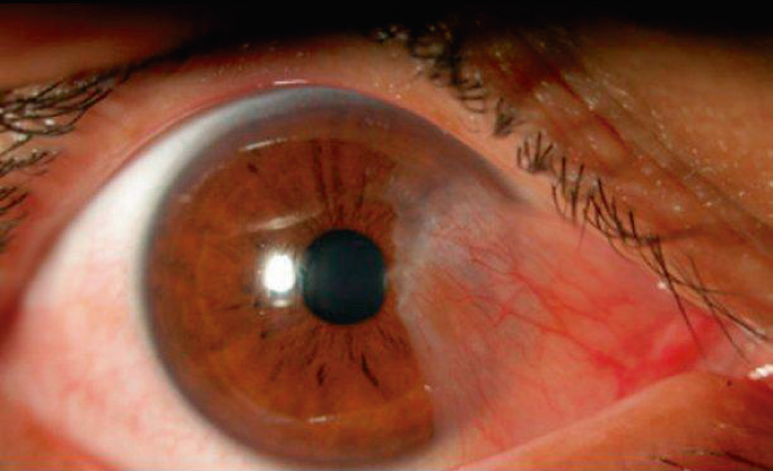 Enfermedades m&aacute;s comunes en los ojos que puedes contraer en verano